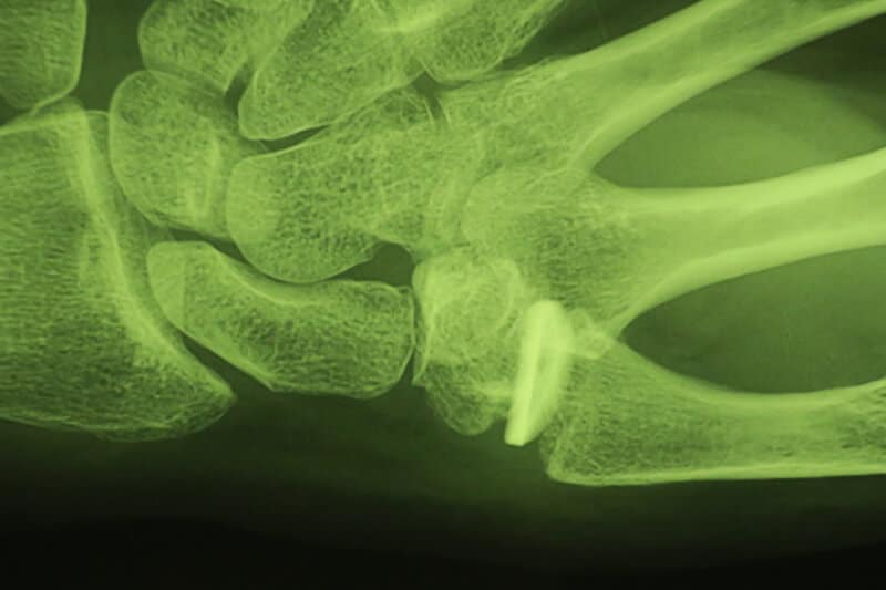Radiographie apres trapezectomie partielle prothese