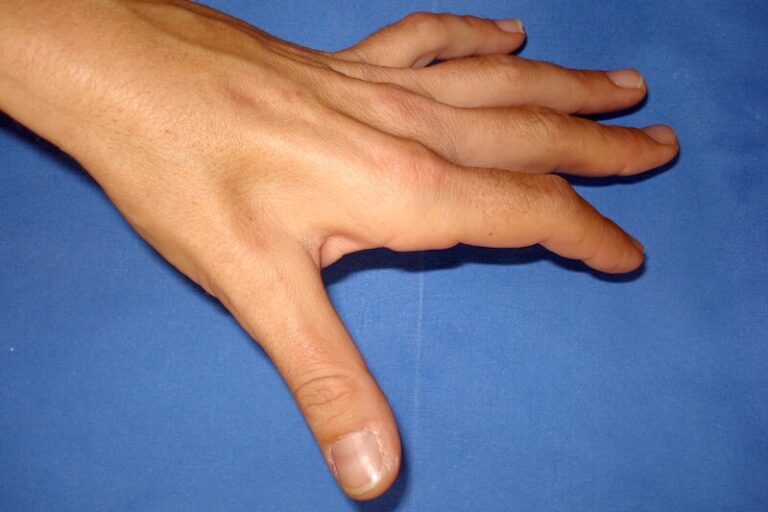 Nerf ulnaire au coude (nerf cubital) Trajet, compression, libération Pr Eric Roulot