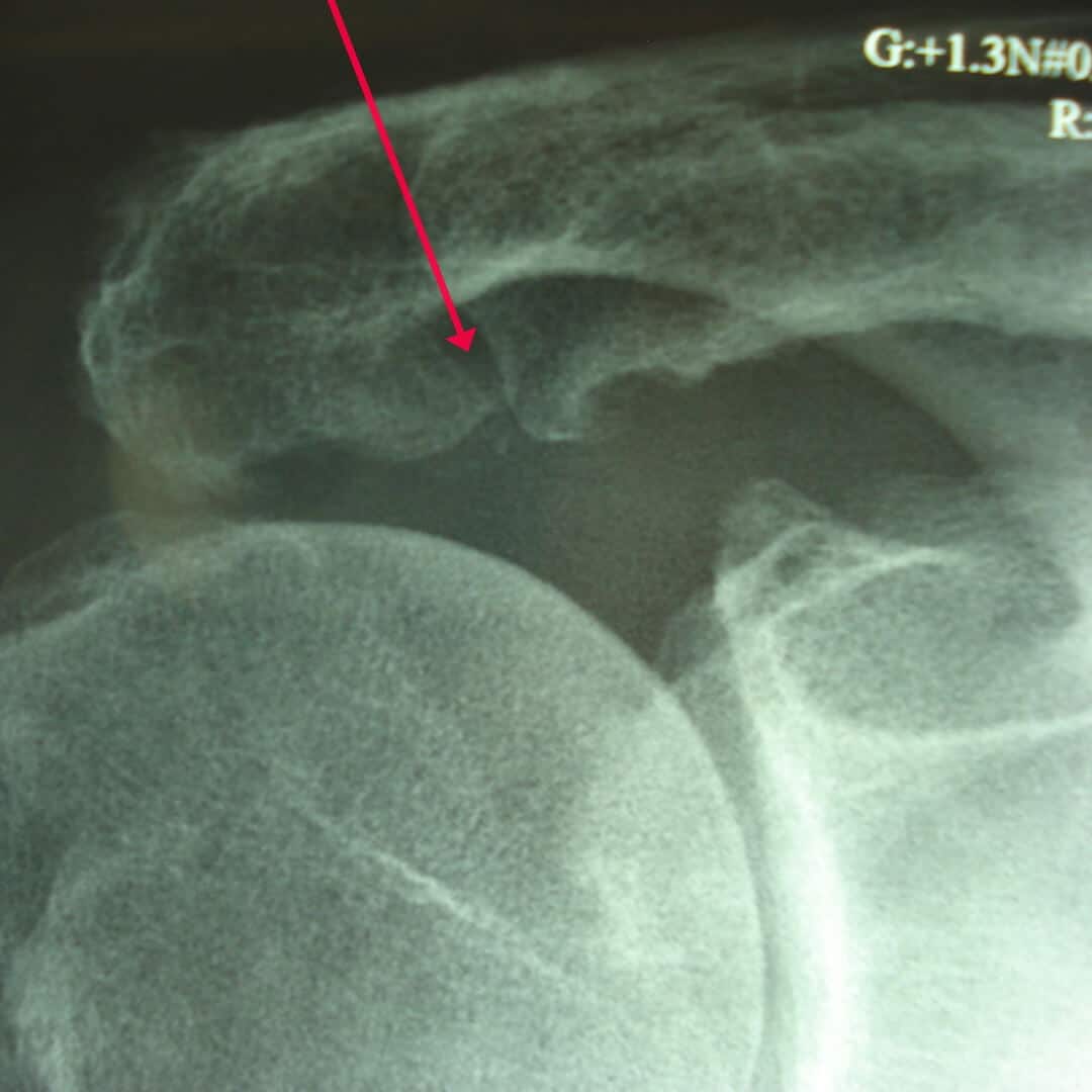 zone infiltration arthropathie acromio claviculaire