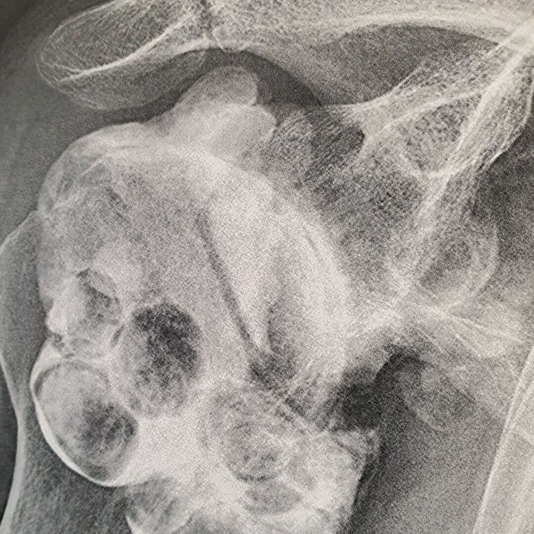 radiographie infiltration arthrose epaule traitement medical