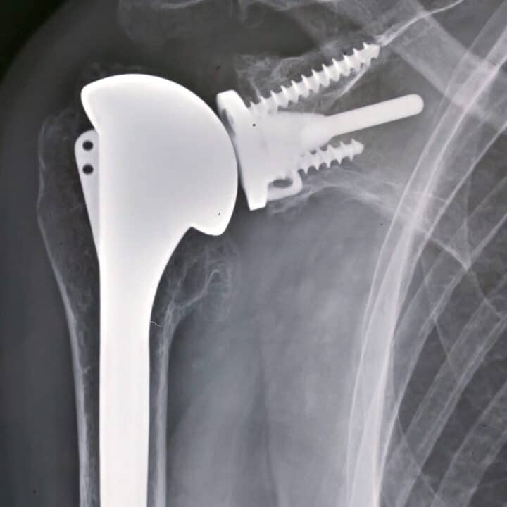 Prothèse d'épaule inversée et anatomique Chirurgie orthopédique Pr Eric Roulot