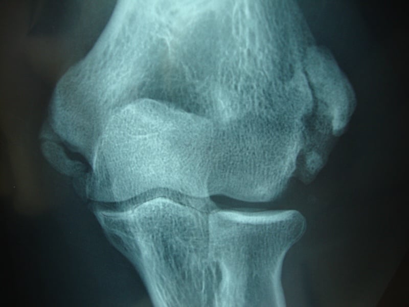 Importantes calcifications à la fois épicondylienne et épitrochléenne