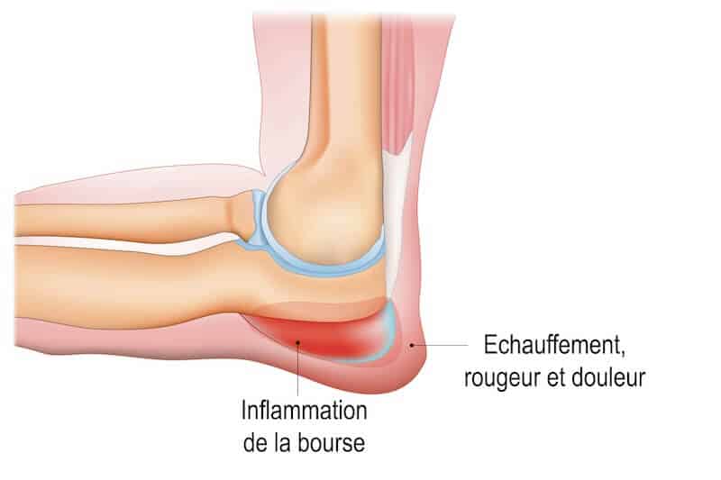 anatomie inflammation bourse hygroma coude