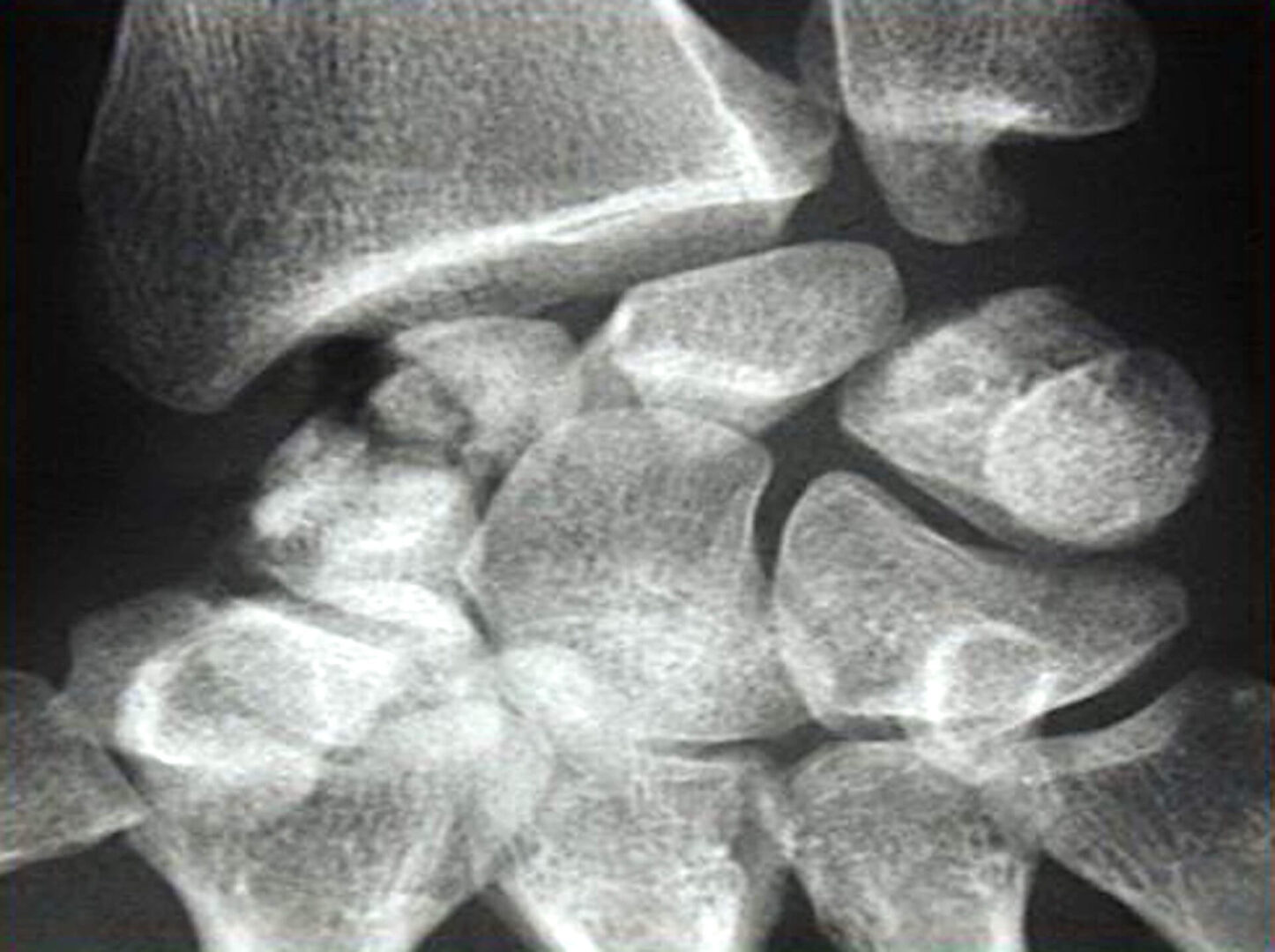 fracture scaphoide