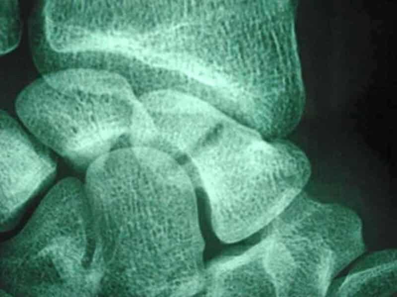 Radio fracture tiers supérieur scaphoïde