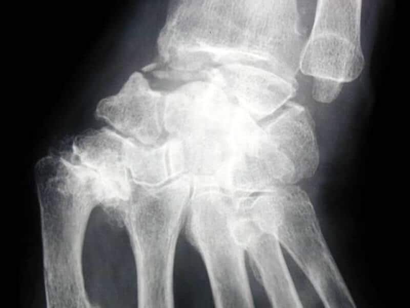 fracture non consolidee