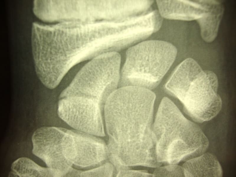 radio fracture enfant necessitant platre