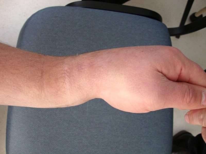 Déformation dos de fourchette cause fracture poignet