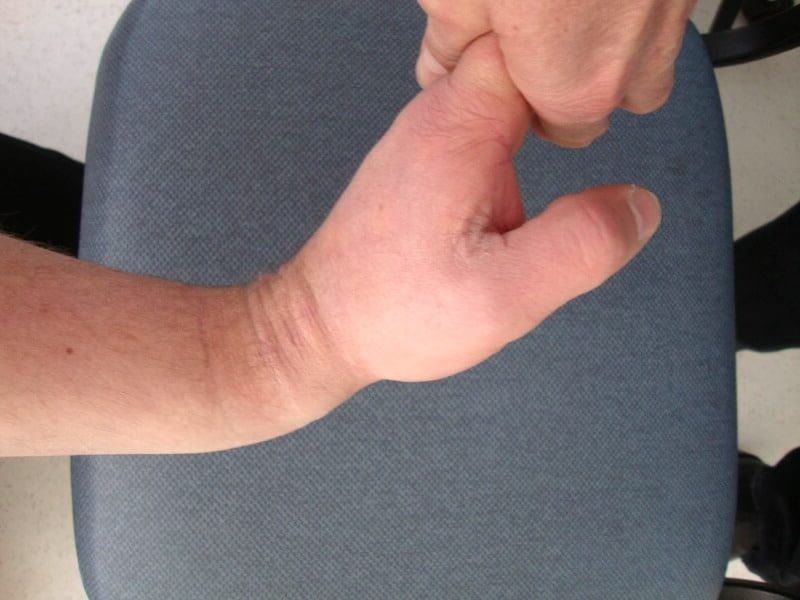 bascule dorsale fracture poignet traumatisme