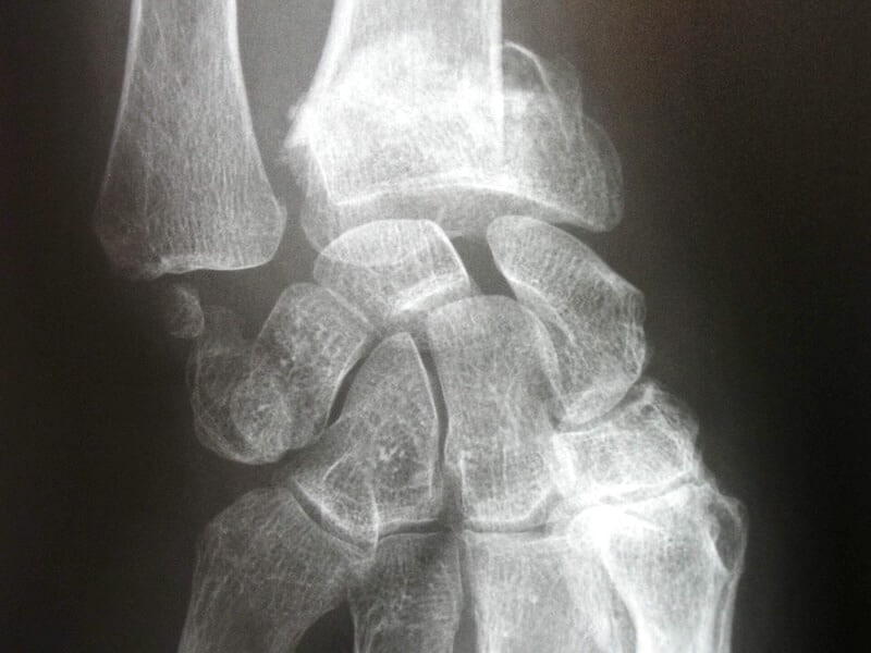 Radiographie de face fracture au poignet