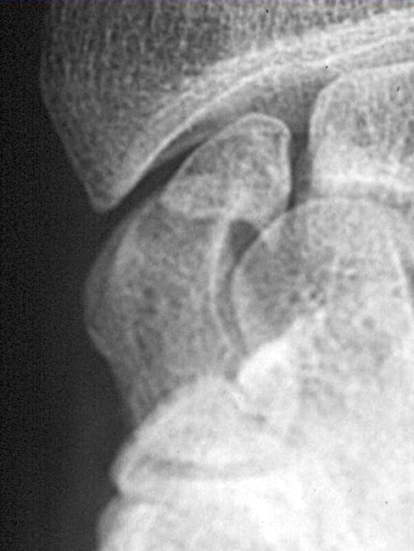 fracture pole proximal