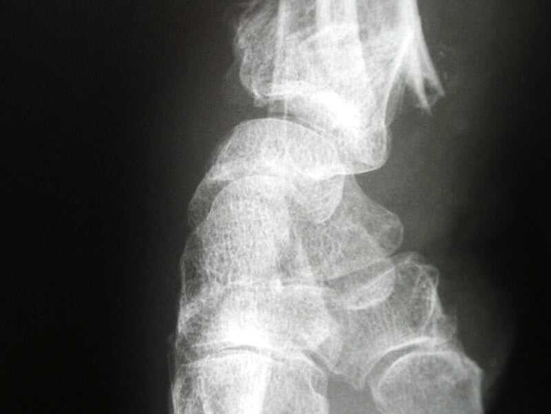 Radiographie profil poignet fracturé
