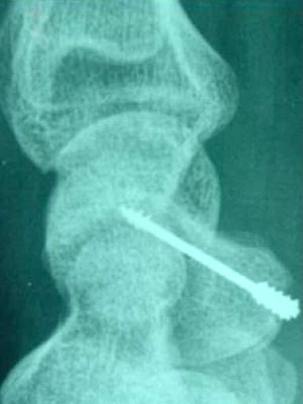 operation scaphoide osteosynthese par vis