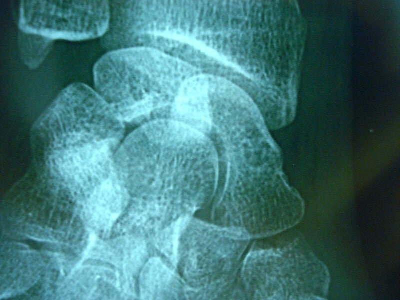 radio fracture scaphoide apres operation
