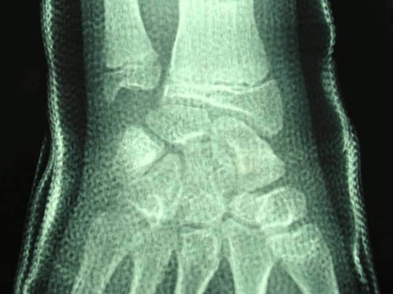 fracture enfant poignet motte de beurre platre face