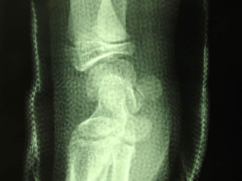 fracture enfant poignet motte de beurre platre profil