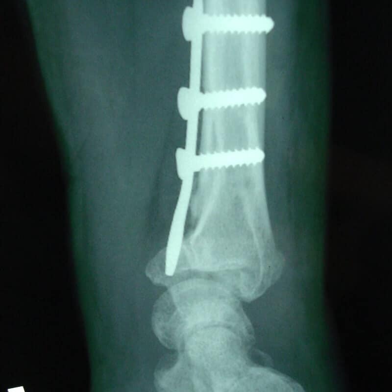 operation fracture poignet vis