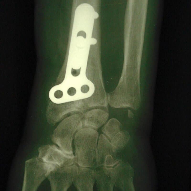 traitement chirurgical fracture poignet plaque vissee
