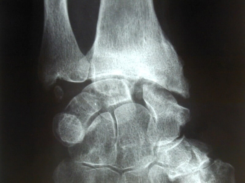 destruction arthrosique carpe os poignet