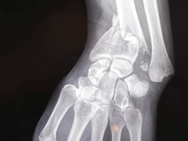 radiographie face fracture avant bras