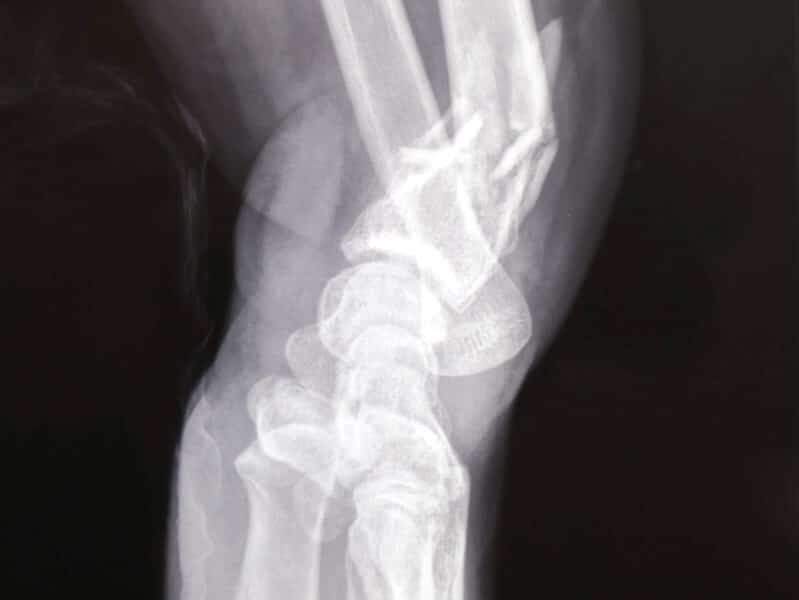 radiographie profil fracture avant bras