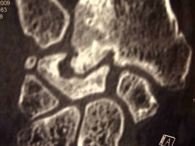 Arthrose severe apres fracture poignet