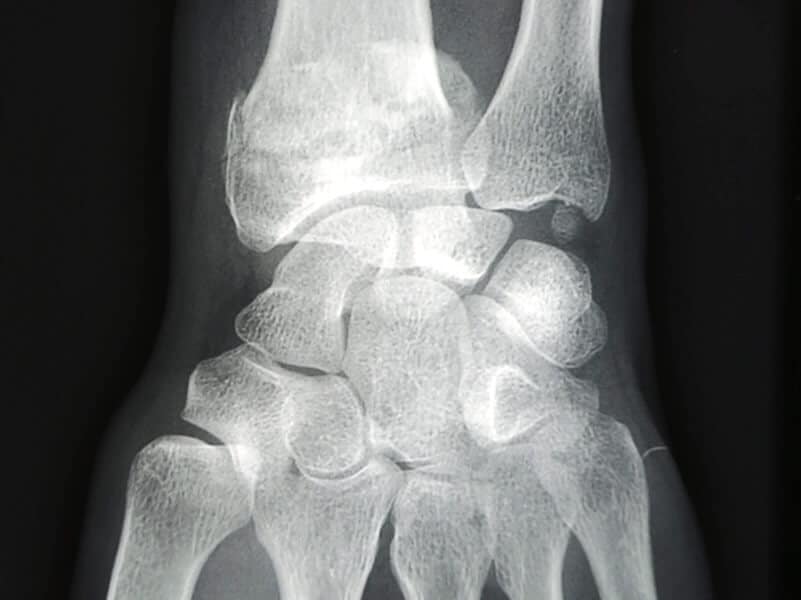Fracture Pouteau-Colles Radiographie de face