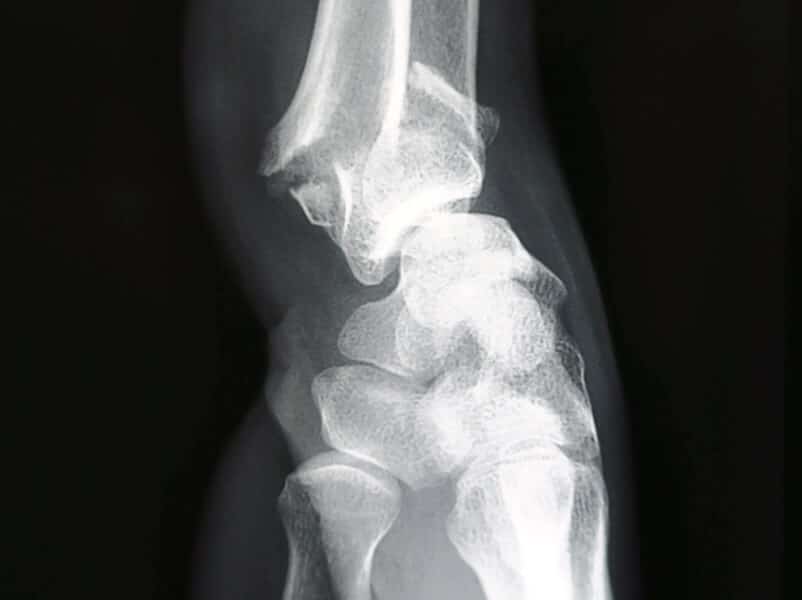 Fracture de Pouteau-Colles​ - Radiographie de profil