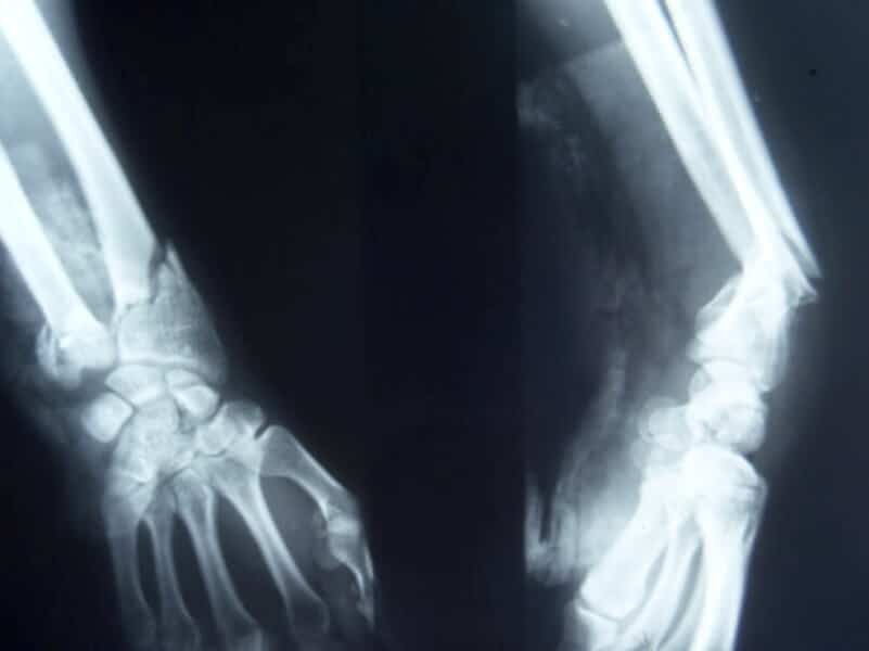 Fracture extra-articulaire deux os avant bras
