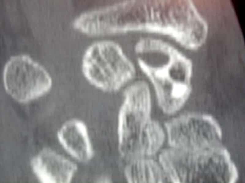 geode intra osseuse scaphoide