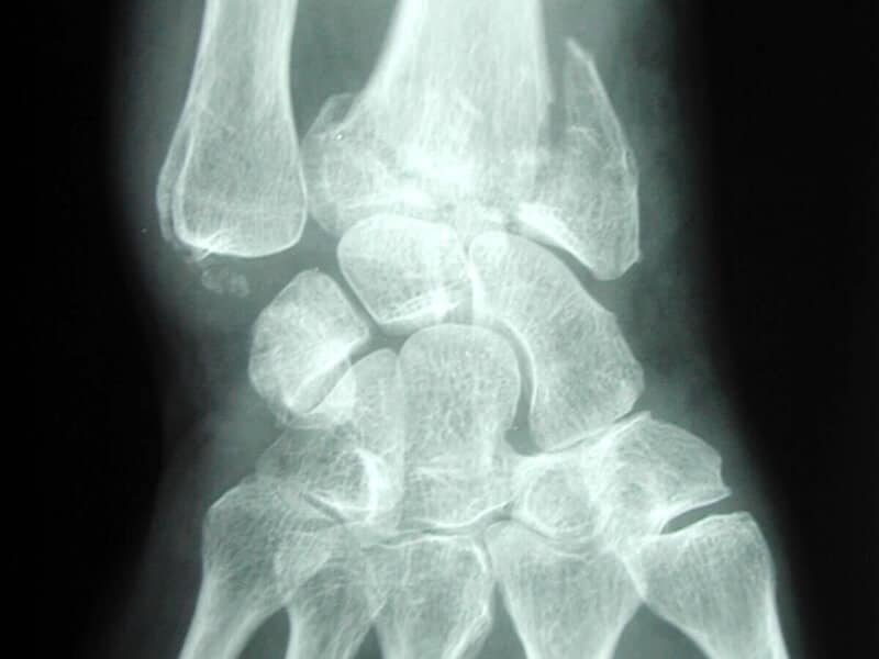 Radio face Fracture articulaire inferieure radius
