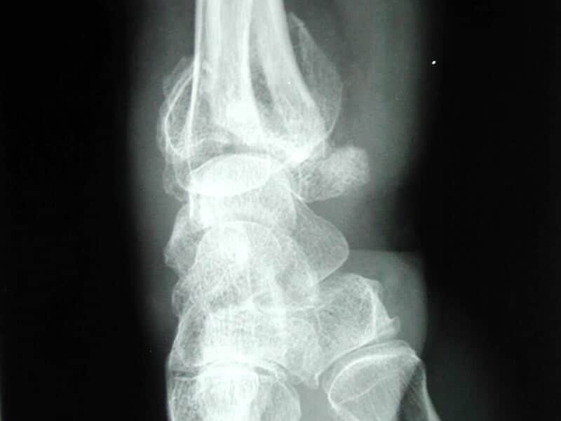 Radio profil fracture articulaire inferieure radius