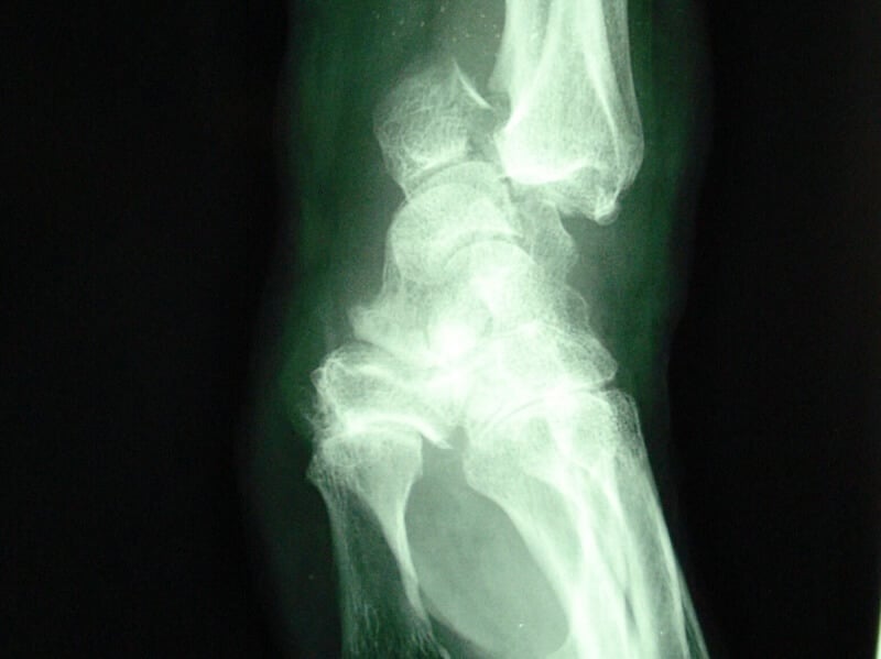 subluxation anterieure du carpe
