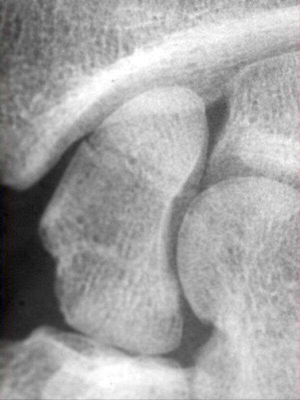 radio fracture tiers superieur
