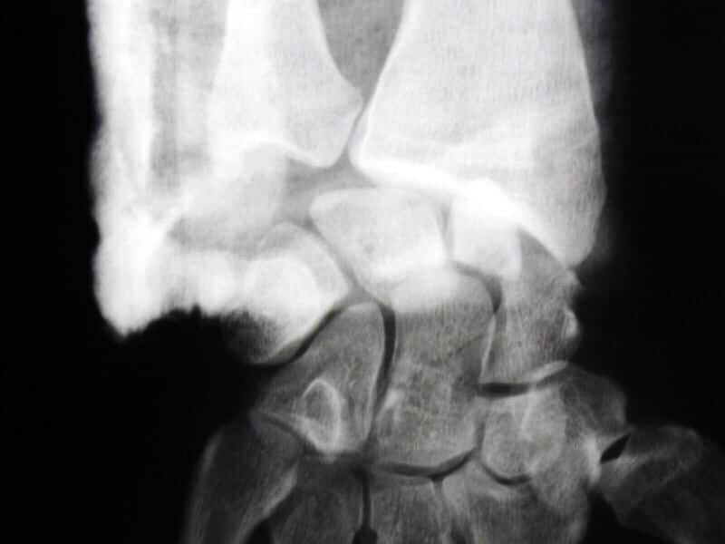 Fracture très déplacée du scaphoïde poignet