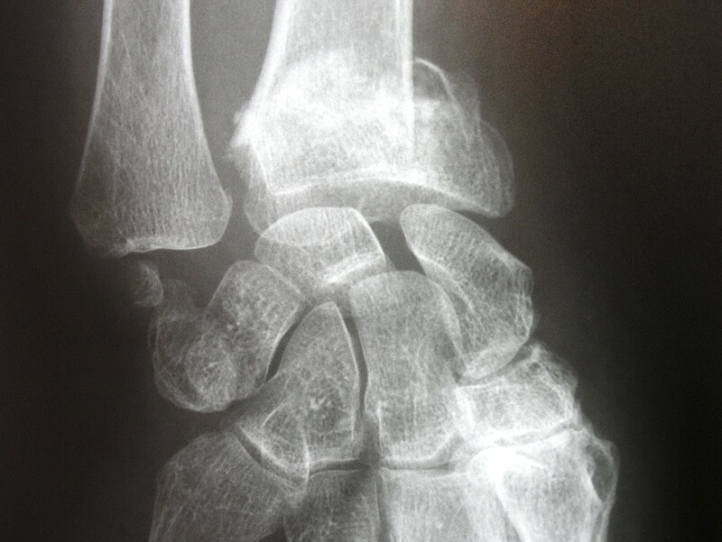 Radiographie face fracture poignet