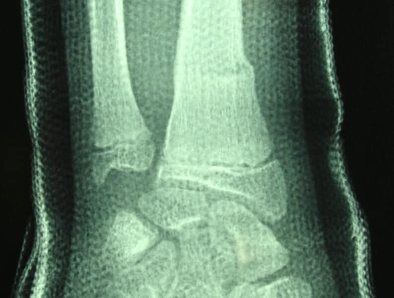 fracture enfant poignet motte de beurre platre face