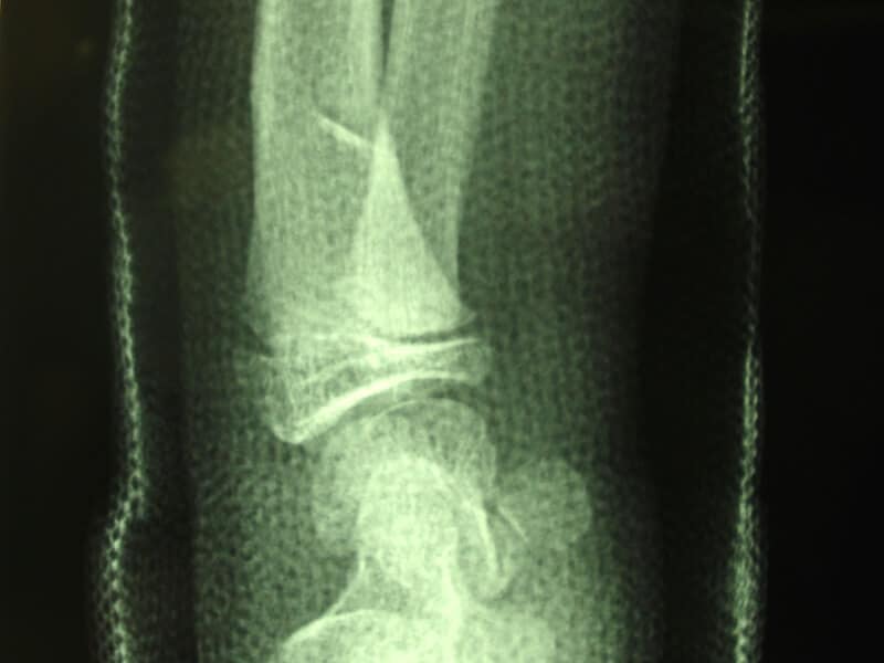fracture enfant poignet motte de beurre platre profil