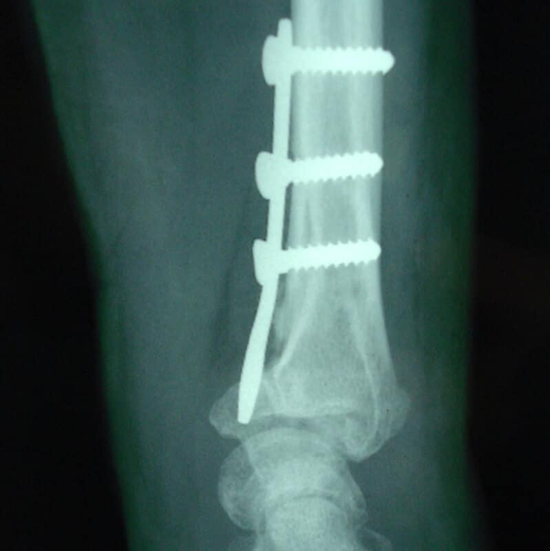 operation fracture poignet vis
