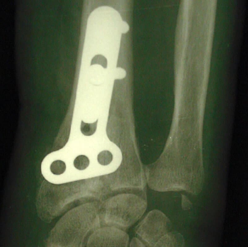 traitement chirurgical fracture poignet plaque vissee