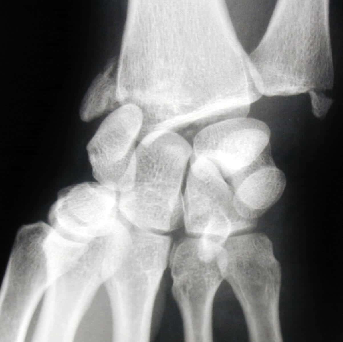 radio entorse luxation premiere rangee os carpe