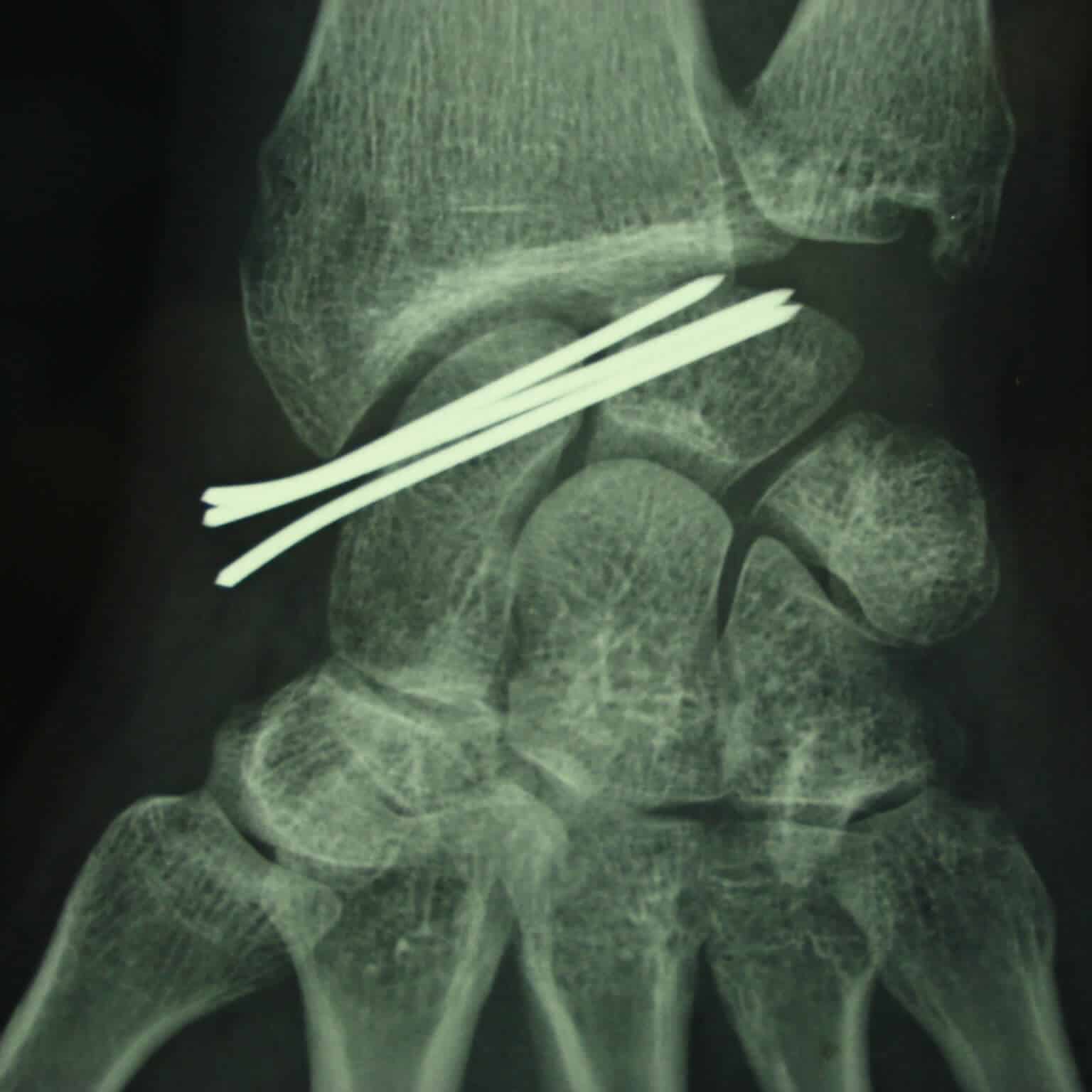 operation chirurgicale entorse au poignet grave