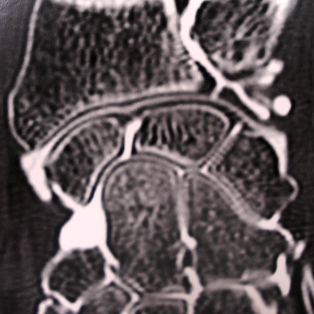 Arthroscanner perforation ligament triangulaire poignet