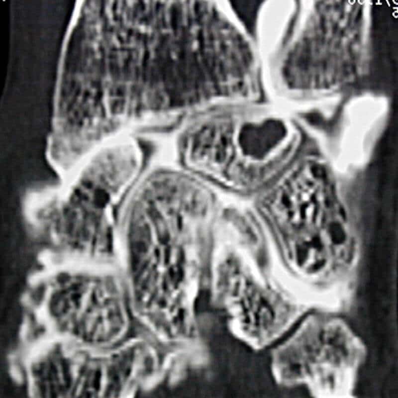 complication entorse du poignee temps de guerison