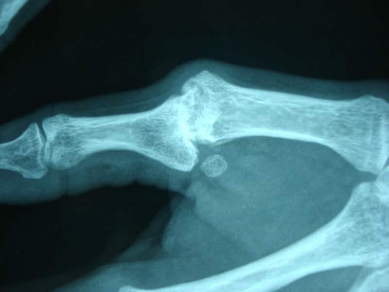 radiographie arthrose suite entorse non traitee chirurgicalement