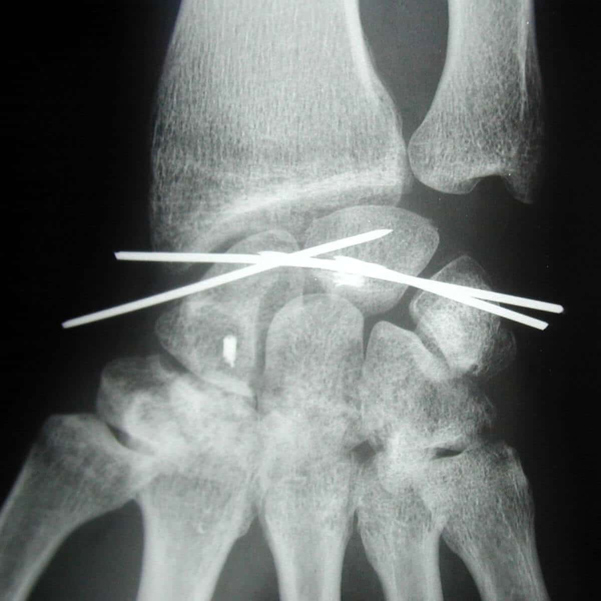 entorse grave ligament poignet operation