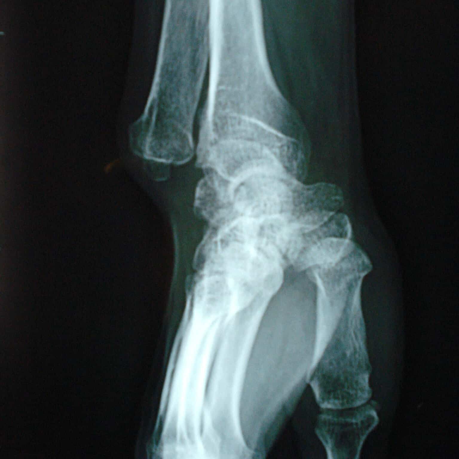 luxation posterieure de la tête ulnaire poignet