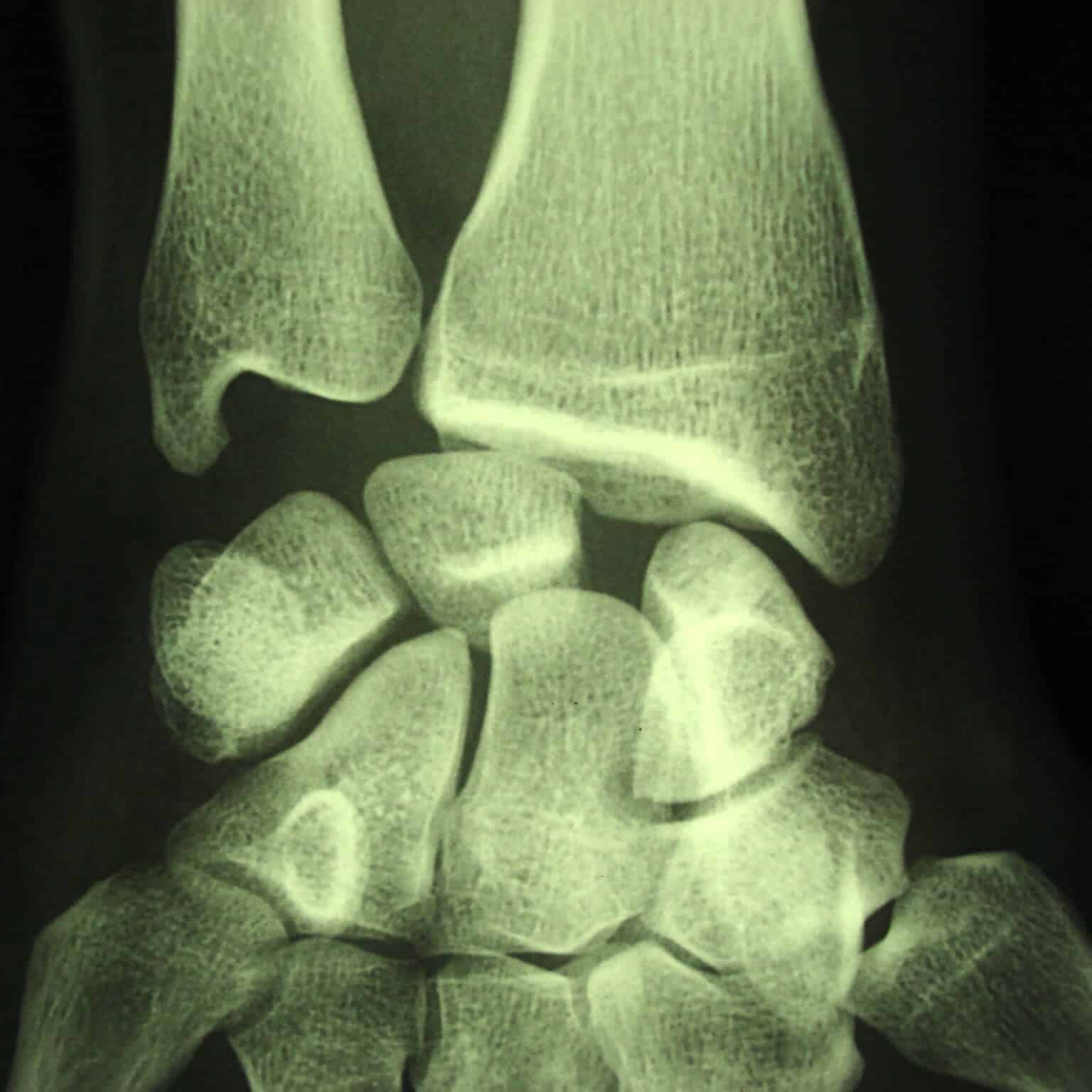 entorse ligament poignet rupture