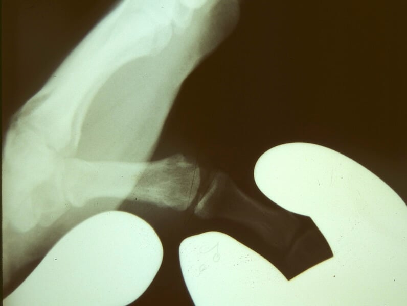 entorse pouce ligament