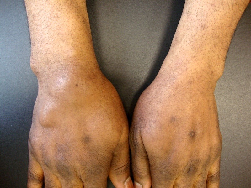 entorse poignet main gonflée droite symptome